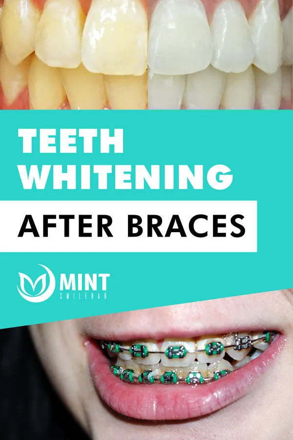 32296 teeth whitening after braces 6