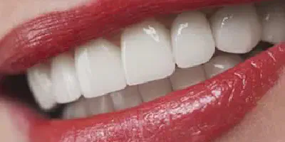 /img/32297-teeth-whitening-aftercare.webp