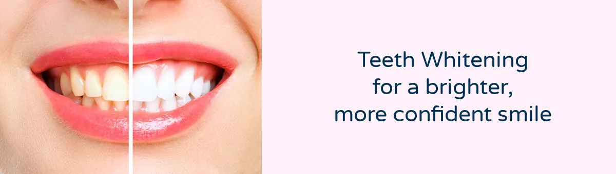 32298 at home teeth whitening