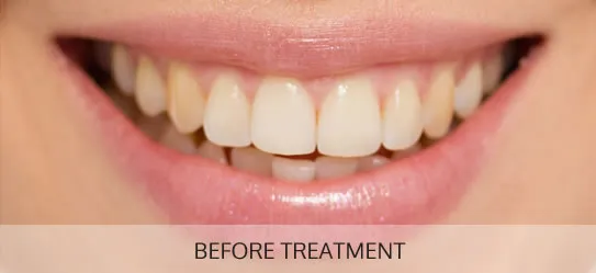 32298 teeth whitening options
