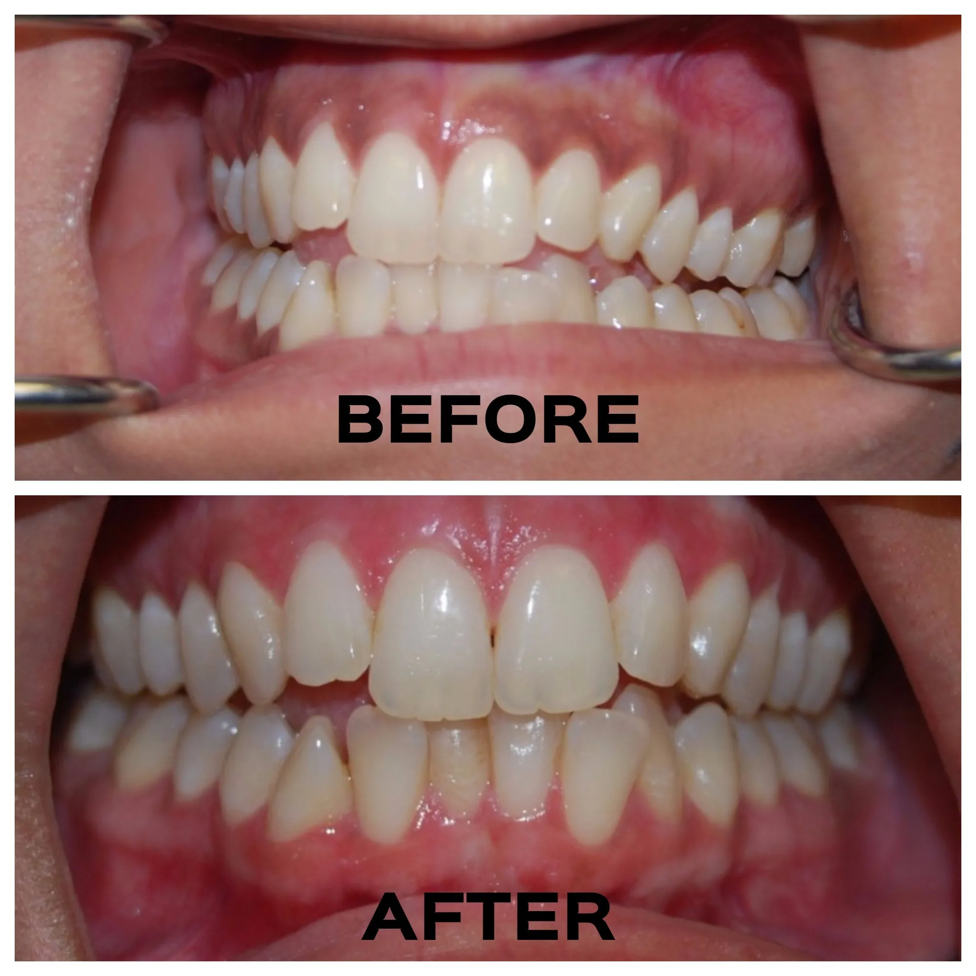 32299 custom fit whitening gum shield