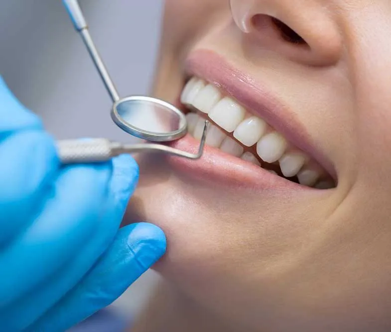 32300 custom whitening trays