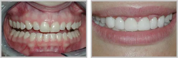 32303 teeth whitening application