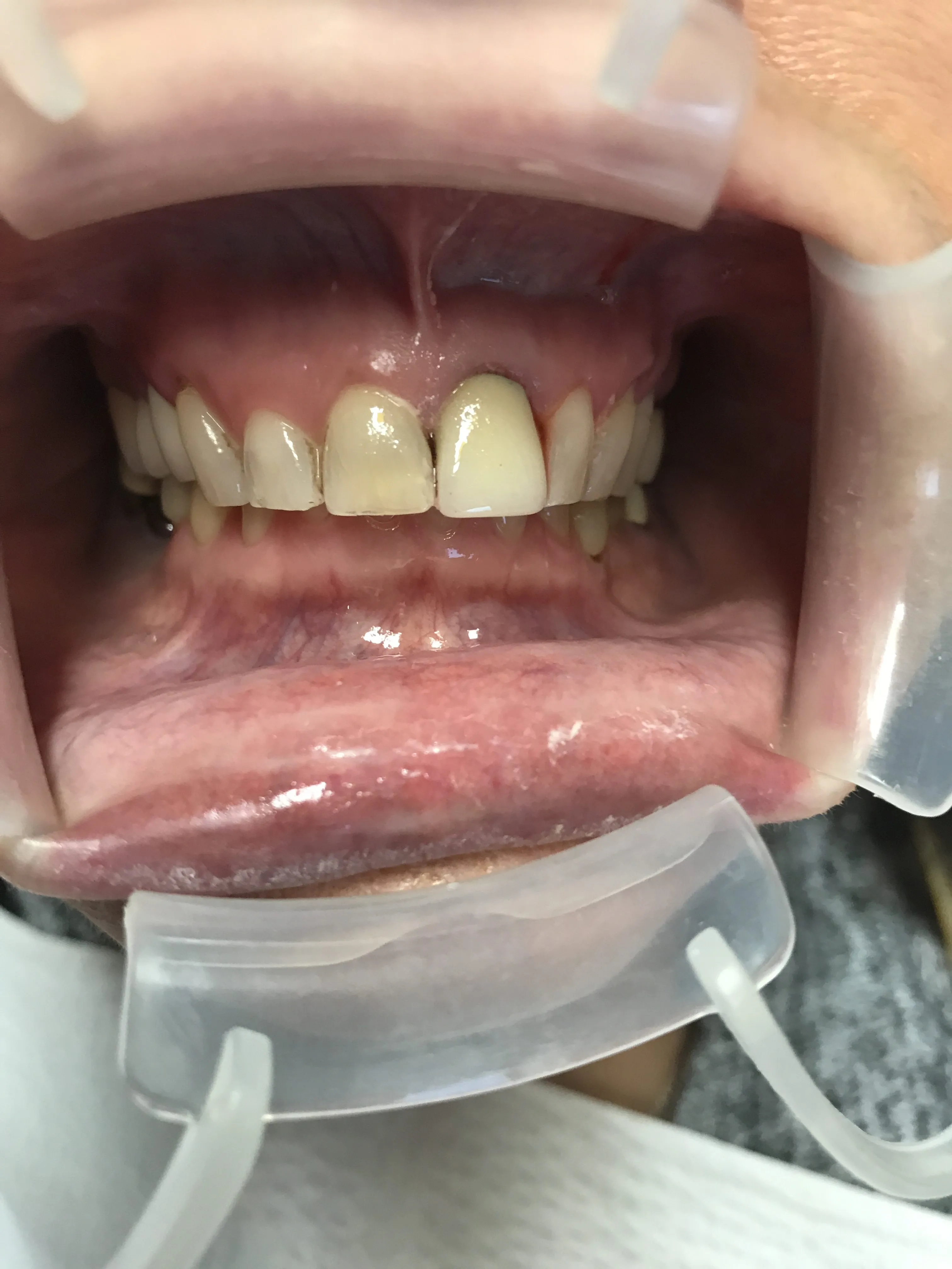 /img/32303-teeth-whitening-smile.webp