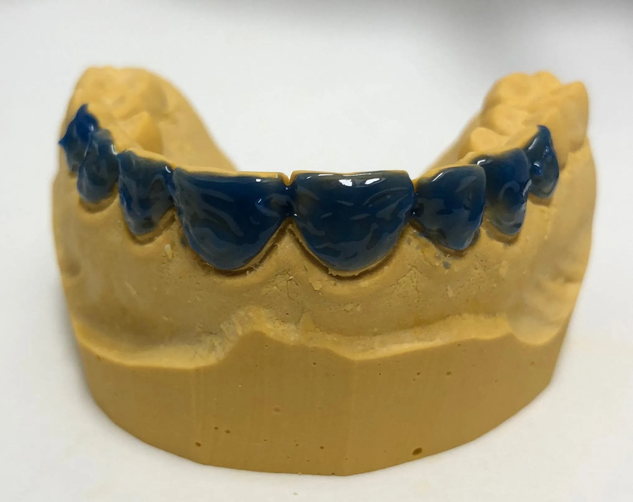 32305 inserting whitening trays