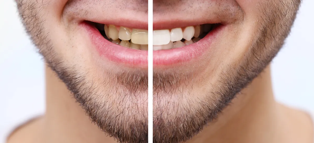 /img/32314-teeth-whitening-process.webp