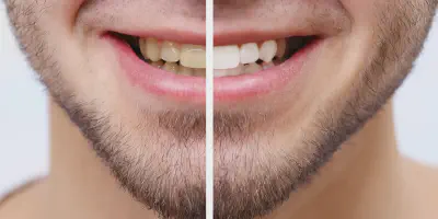 /img/32314-teeth-whitening-process.webp