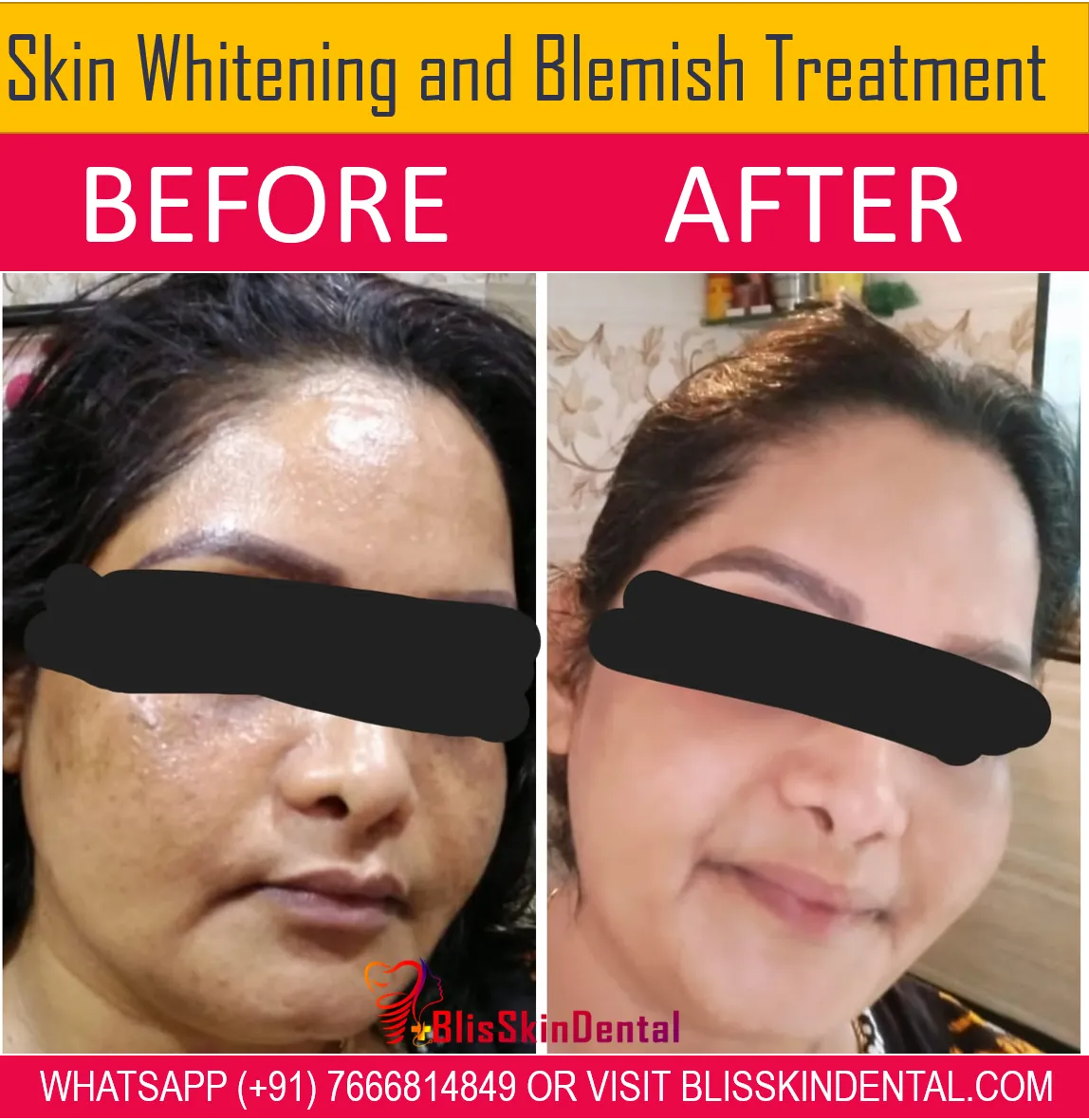 32315 laser skin whitening mumbai