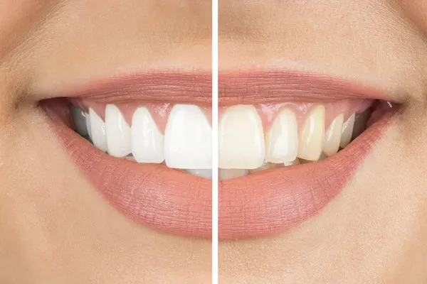 32317 foods to avoid whitening