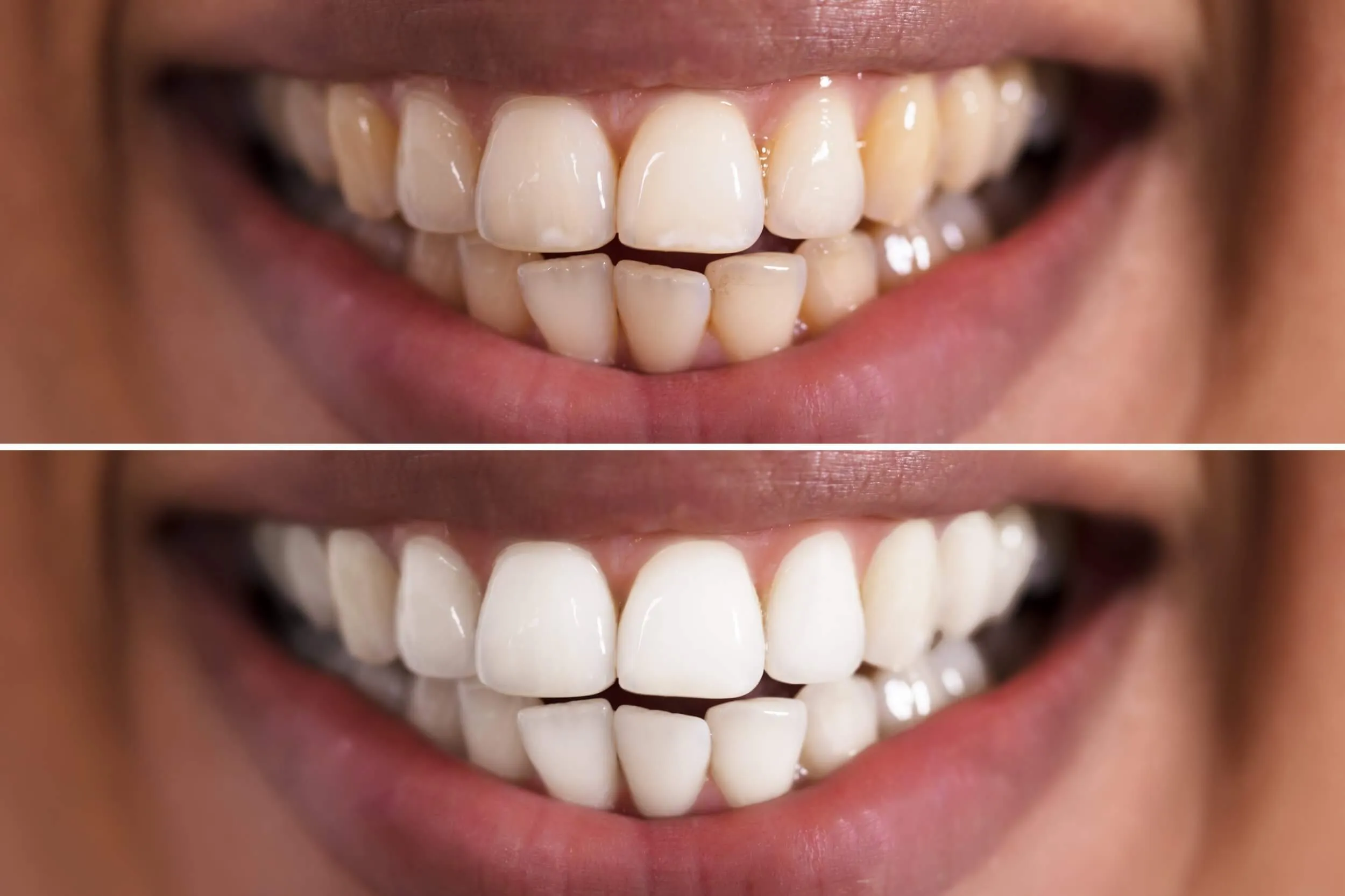 32319 teeth whitening clinic birmingham