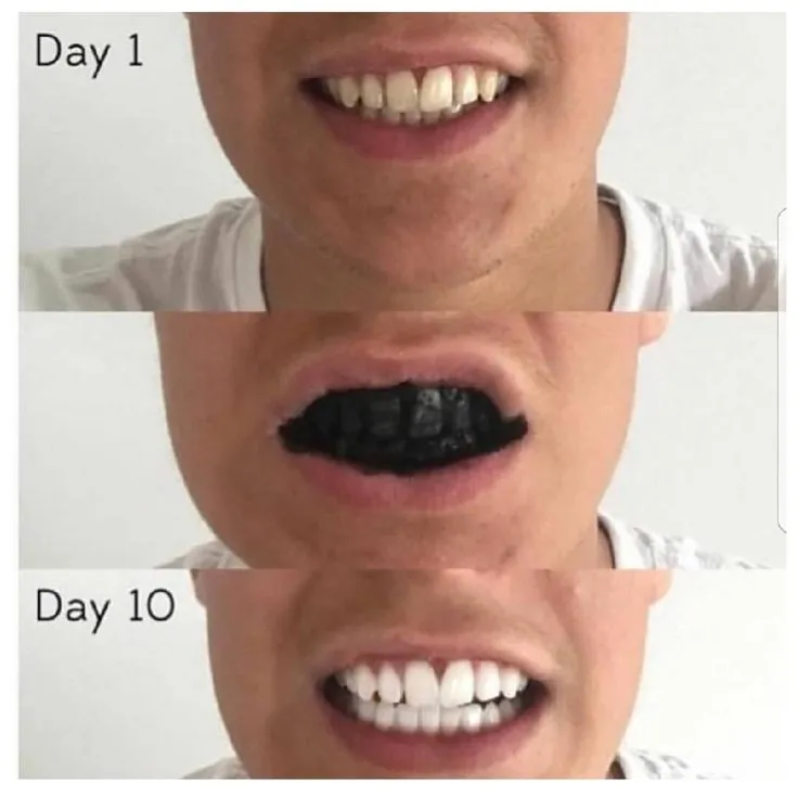 32323 charcoal teeth whitening powder uk results