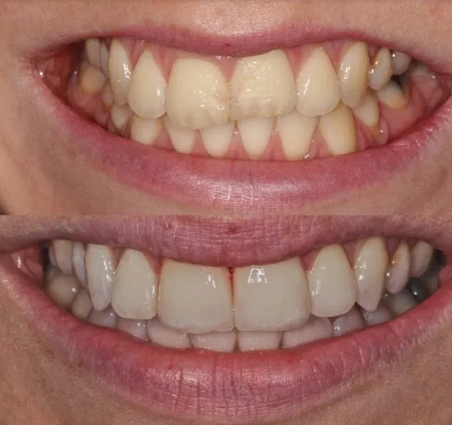 32327 choosing whitening strips