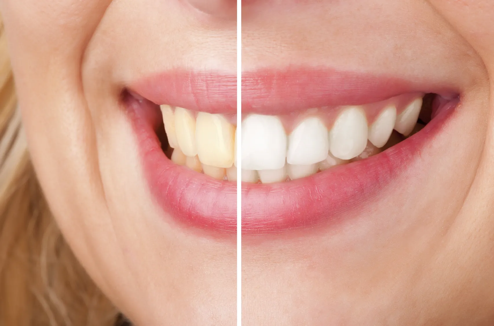 32327 whitening strips and enamel