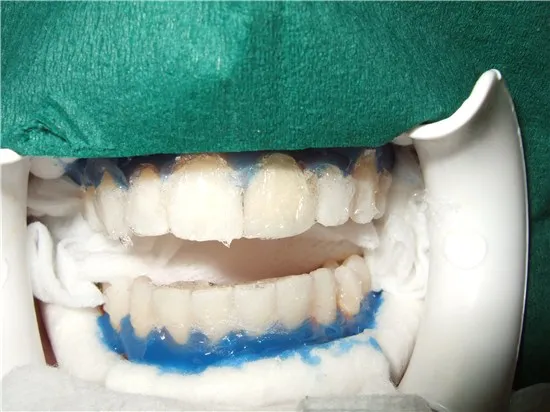 32329 houston tooth whitening smiling