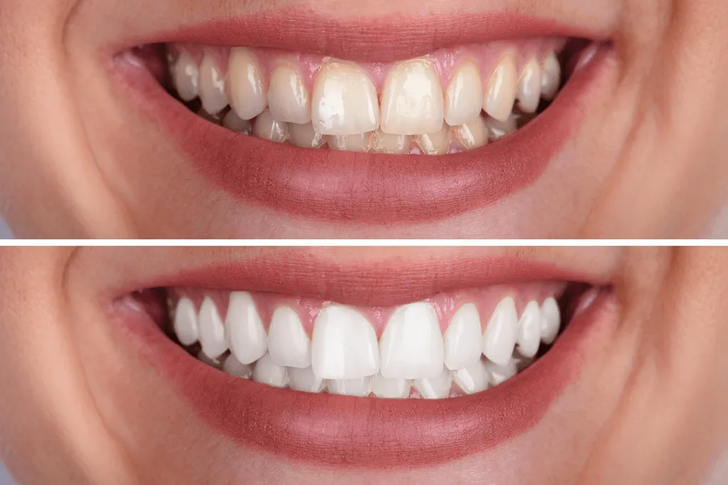 32329 in office teeth whitening