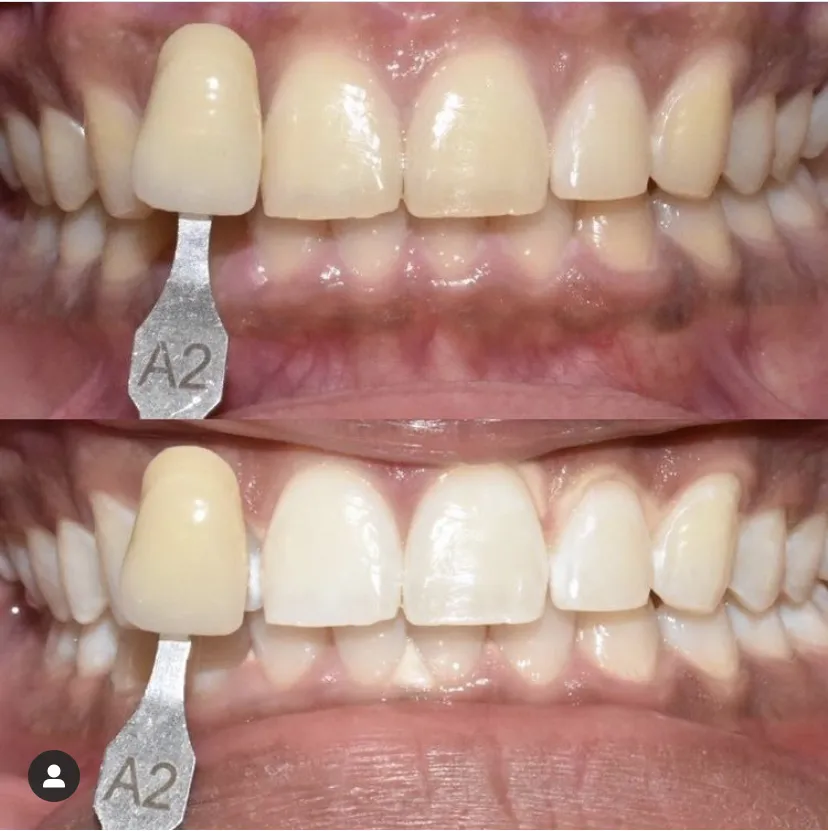 32329 take home teeth whitening kits