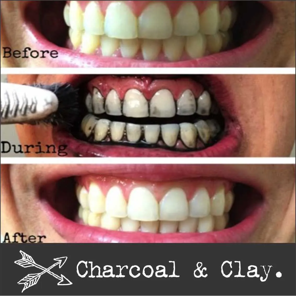 32335 teeth whitening application