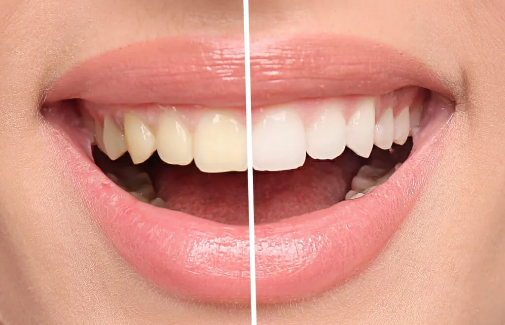 32337 teeth whitening alternatives