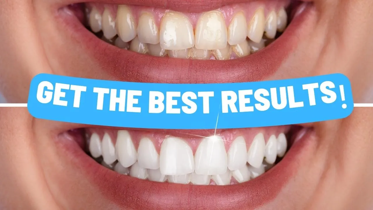 32342 in office whitening