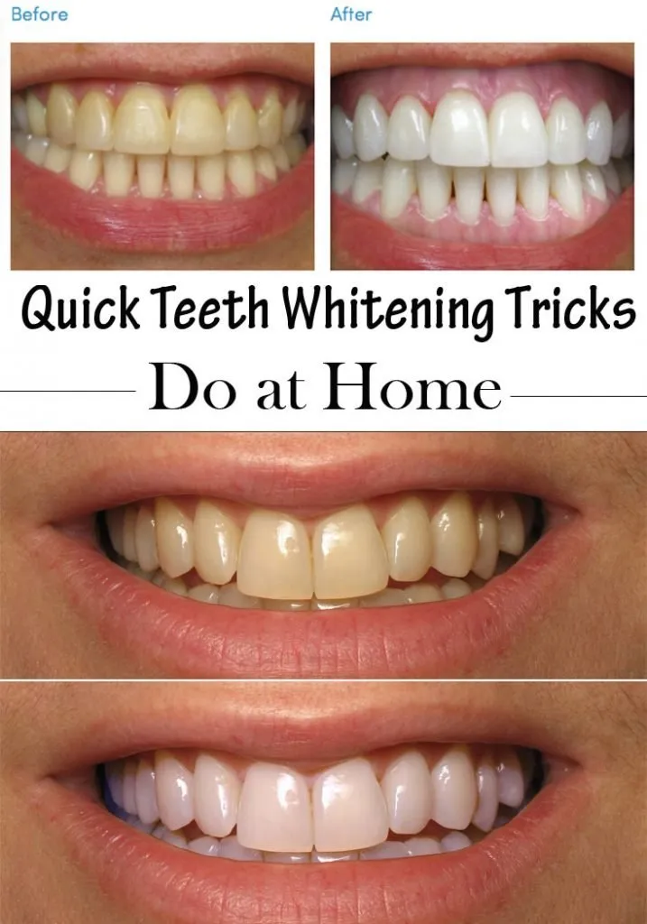 32342 teeth whitening steps