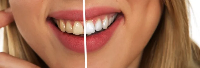 32345 chemical burn gums