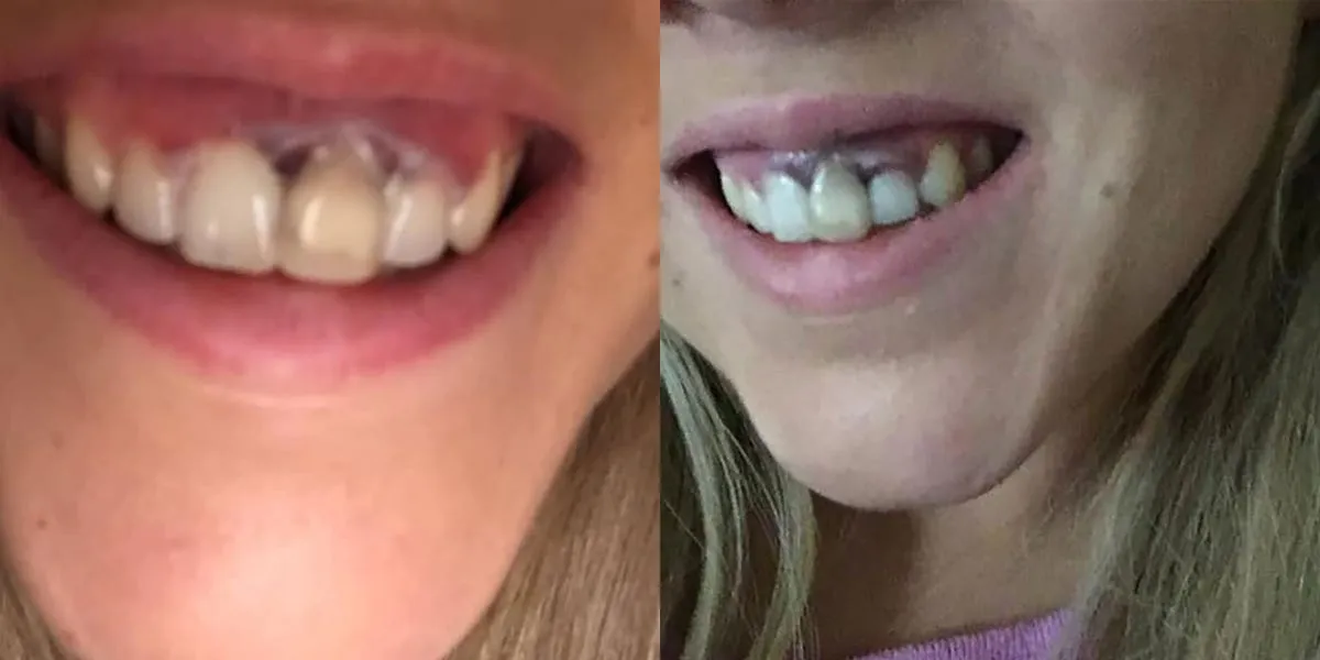 32345 gum recession teeth whitening
