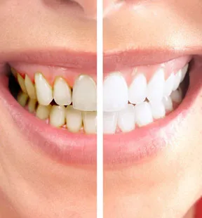 32345 protective measures teeth whitening
