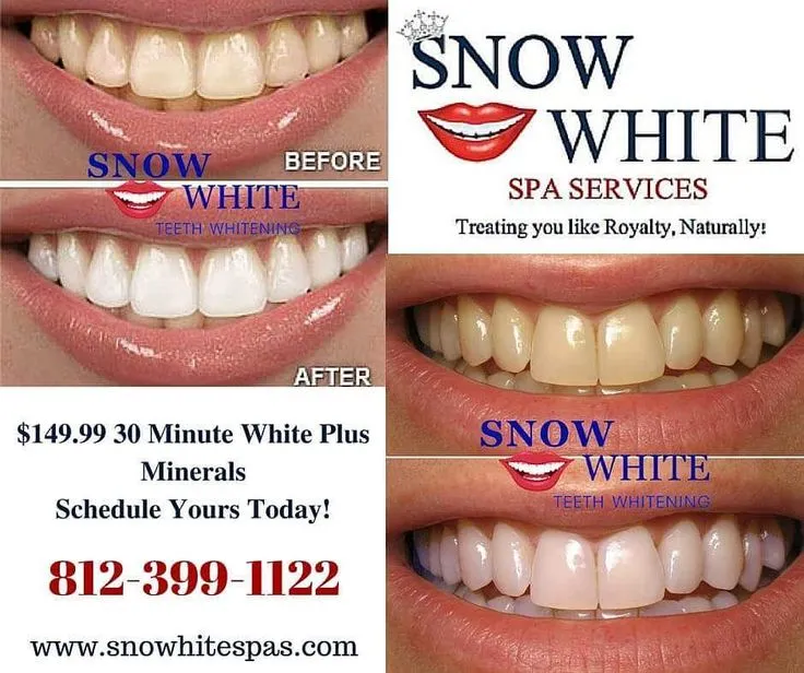 32349 in office whitening