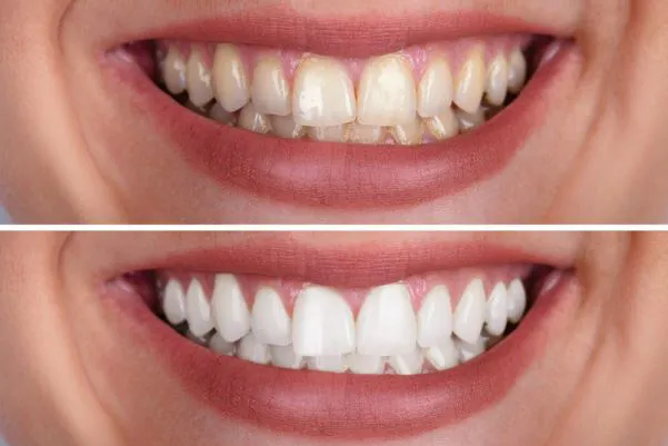 32349 stained teeth causes