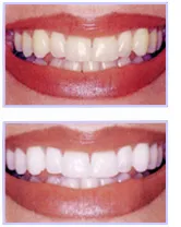 32352 at home teeth whitening kit