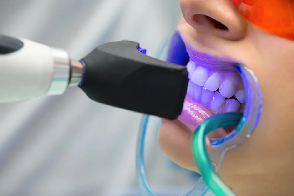 32357 teeth whitening light science