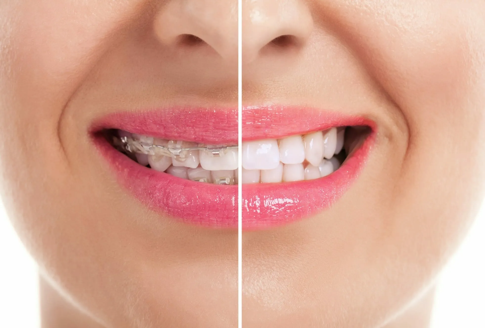 32358 teeth whitening after braces image2