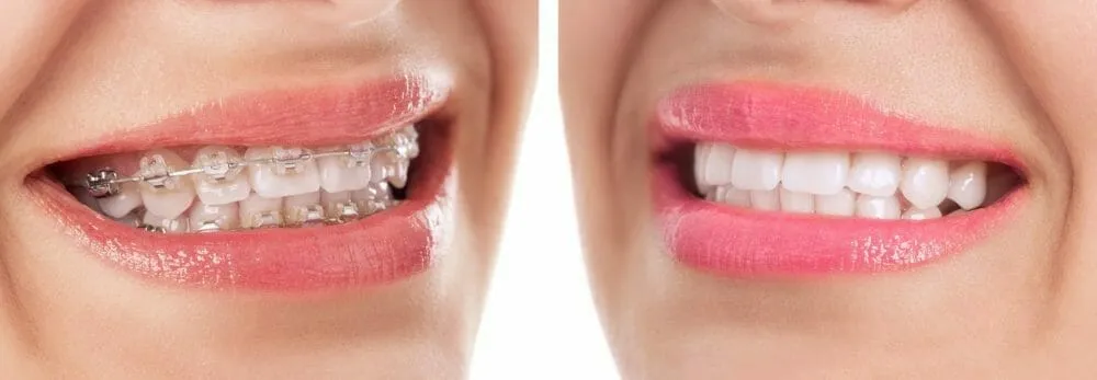 32358 teeth whitening after braces image3
