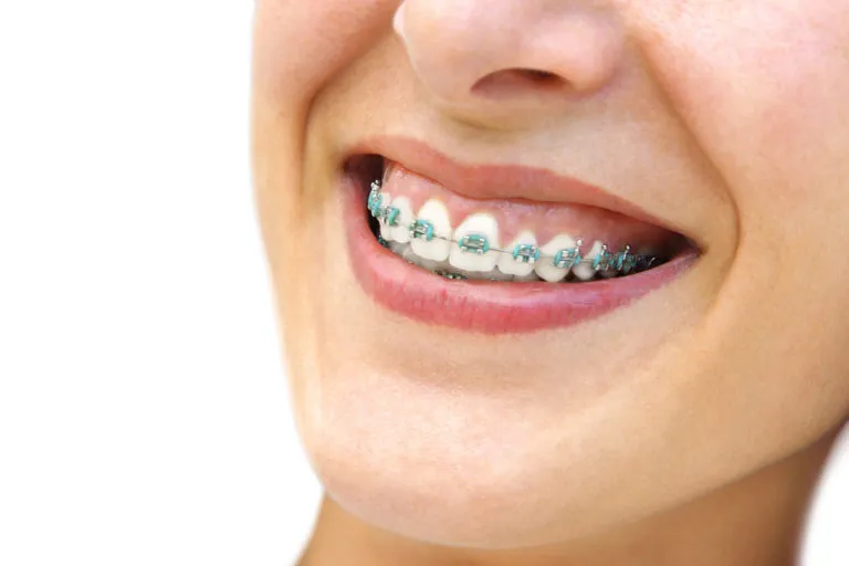 32358 teeth whitening after braces image5