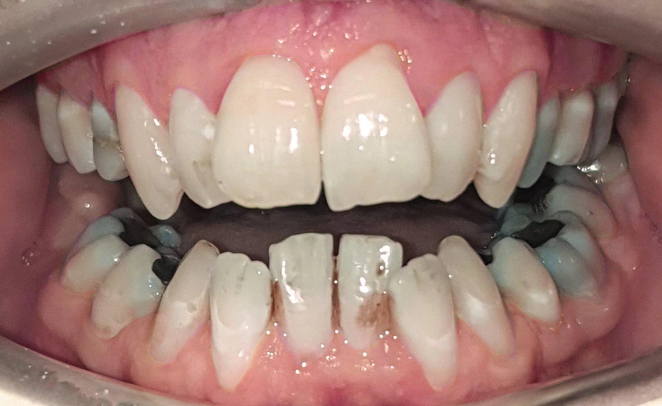 32359 customized whitening trays