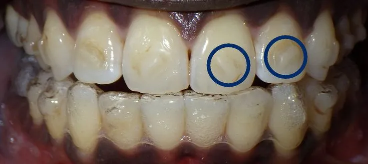 32359 invisalign attachments