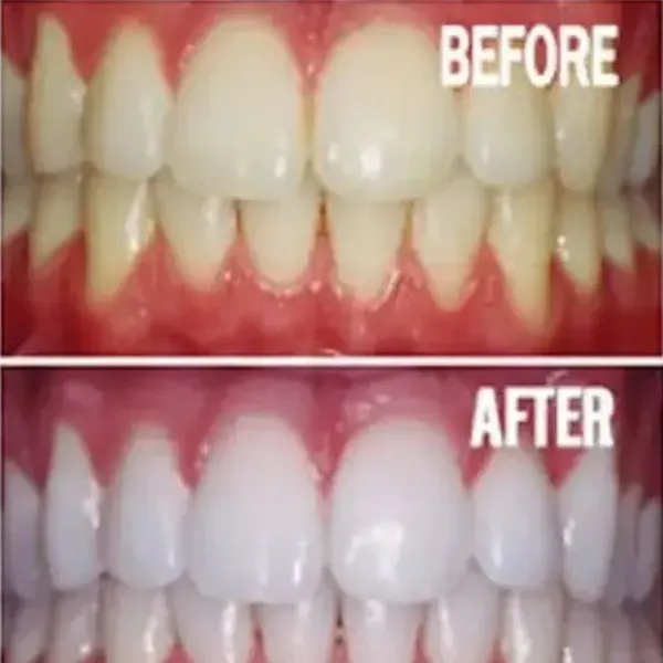 32360 teeth whitening portland dentist