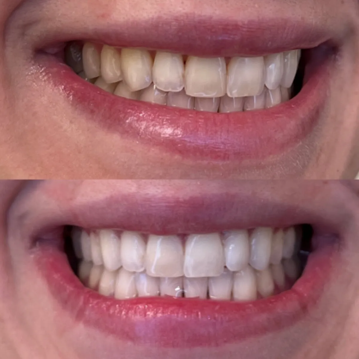 32360 teeth whitening portland office