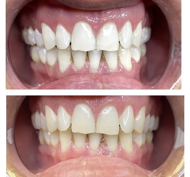 /img/32360-teeth-whitening-portland-results.webp