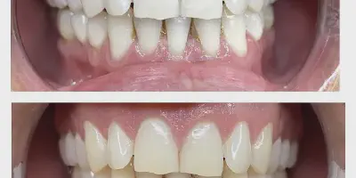 /img/32360-teeth-whitening-portland-results.webp