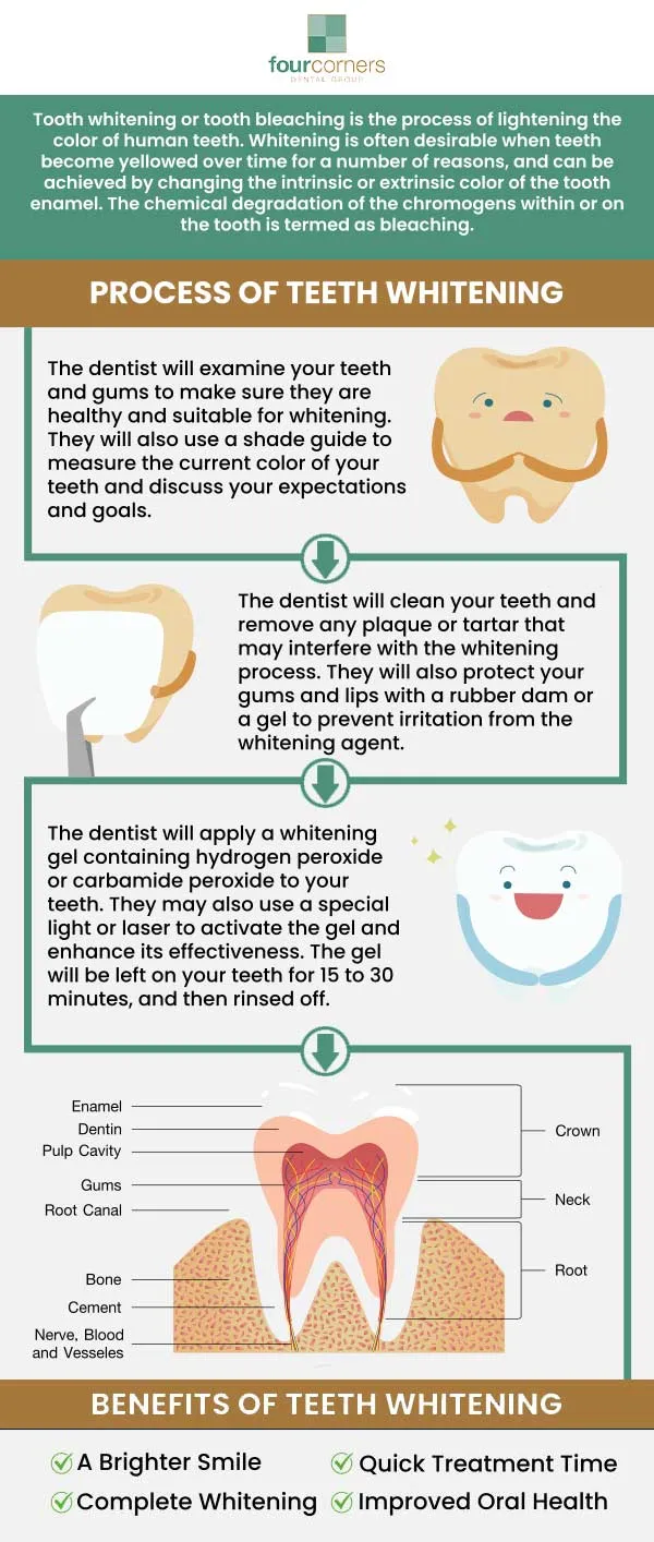 32366 at home teeth whitening kit