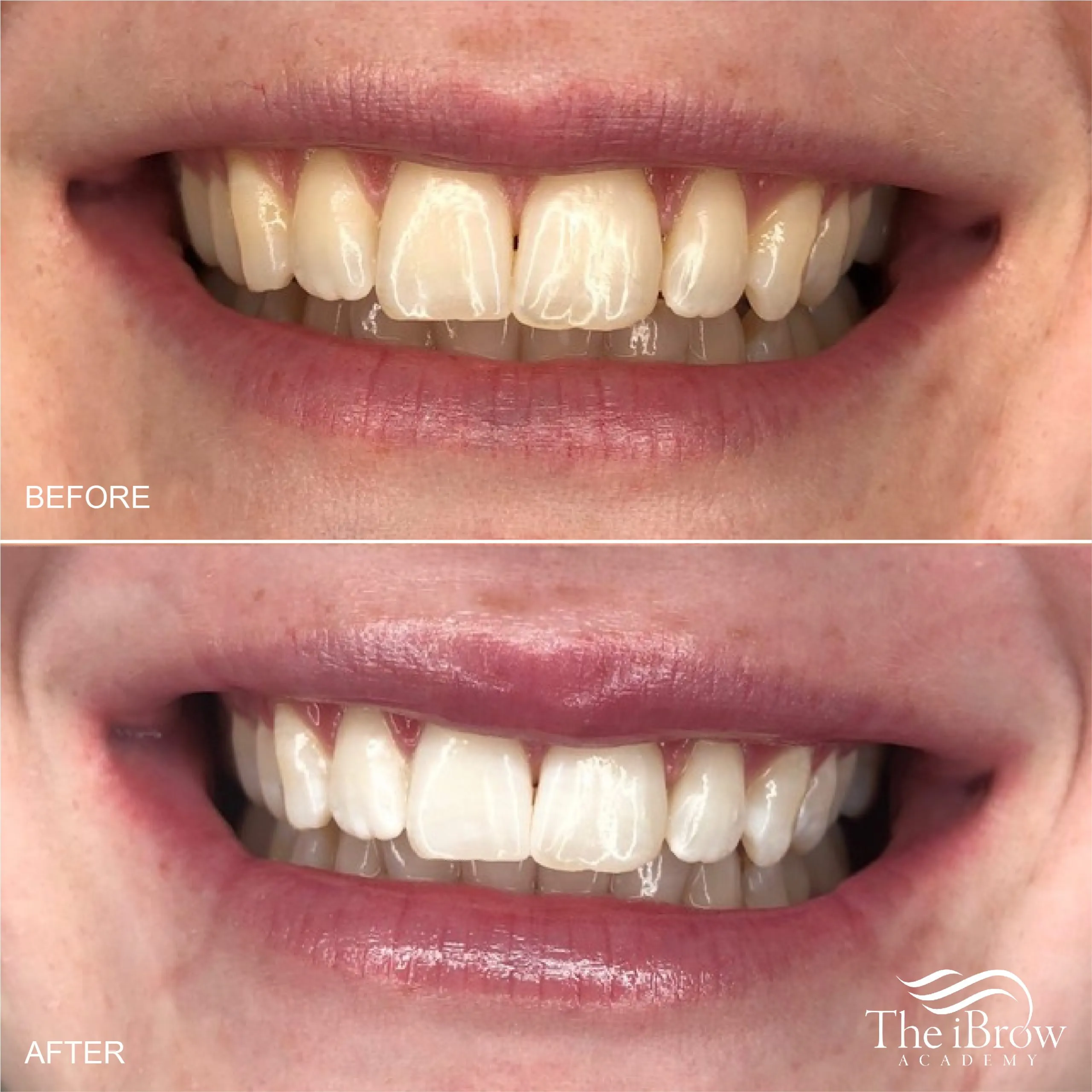 32366 teeth whitening procedure