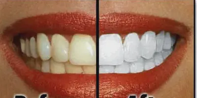 /img/32367-healthy-smile.webp