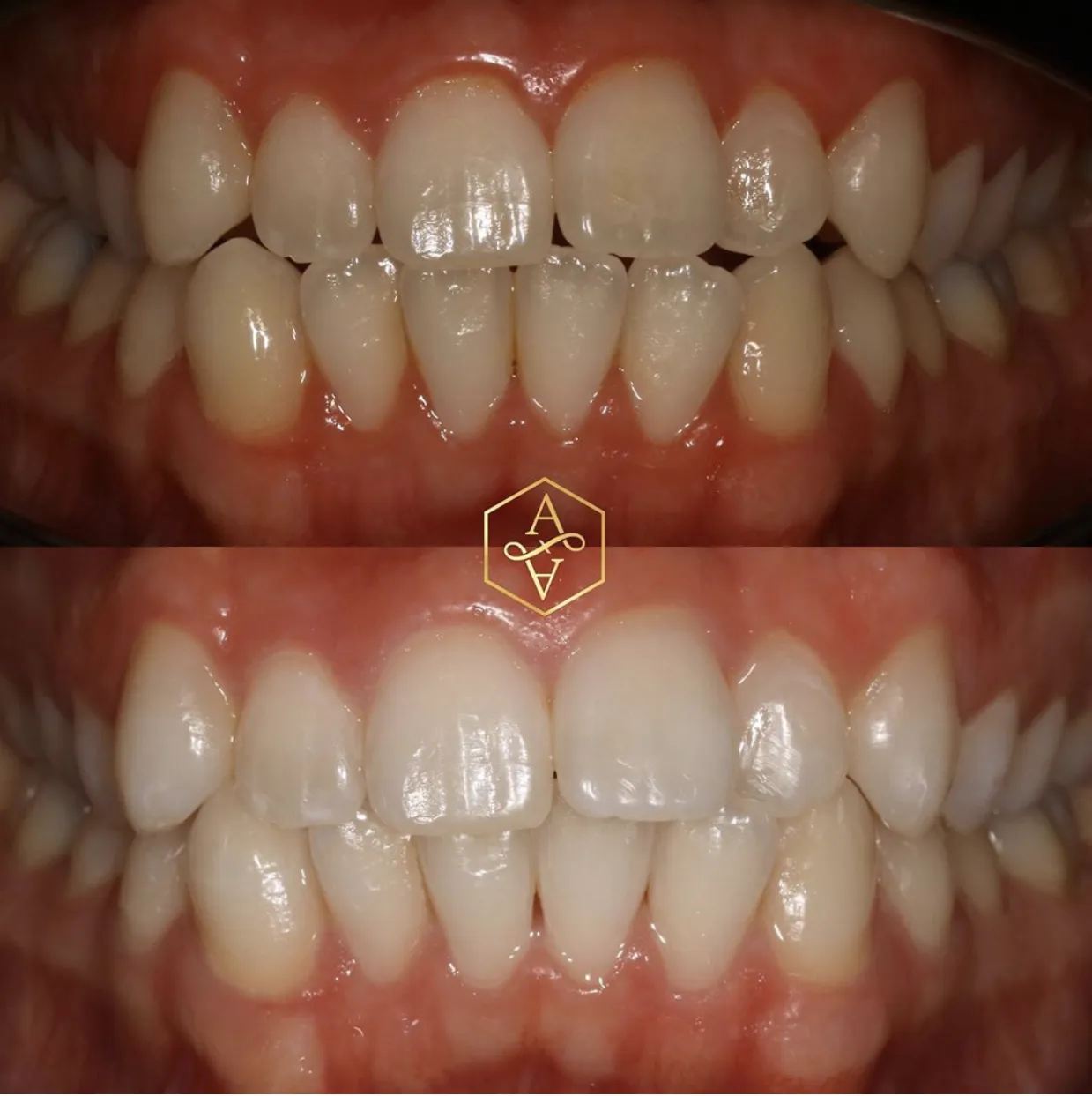 32370 teeth whitening yarm image2