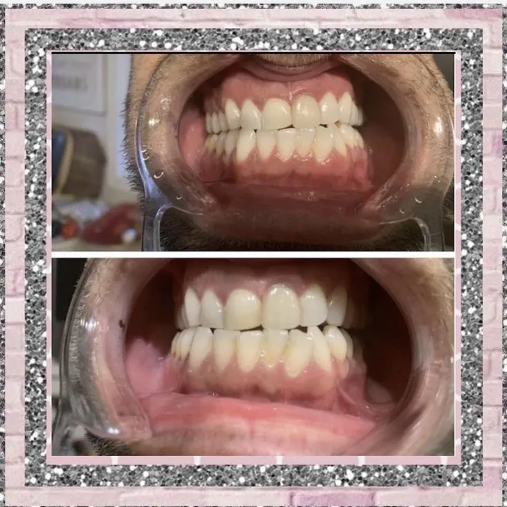 /img/32370-teeth-whitening-yarm-image7.webp