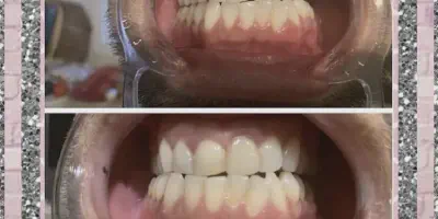 /img/32370-teeth-whitening-yarm-image7.webp