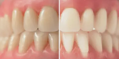 /img/32371-healthy-smile-oral-health.webp