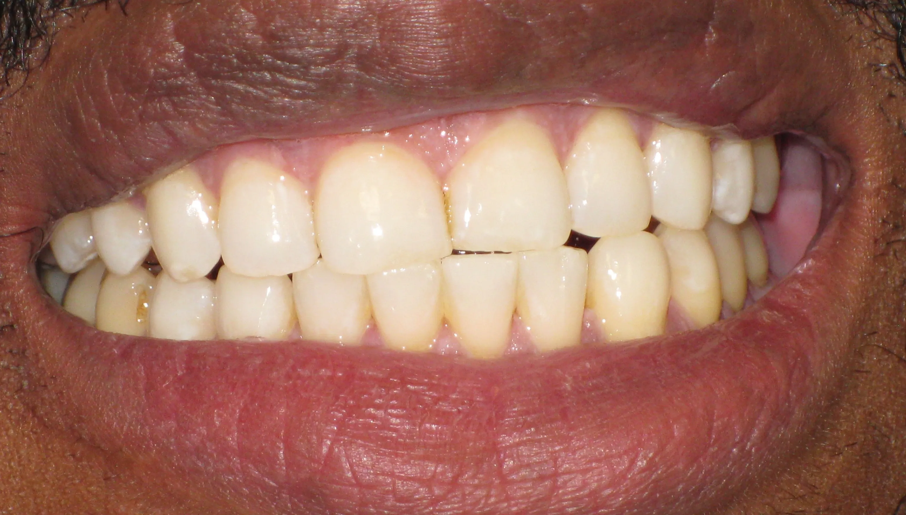 32375 teeth whitening before after