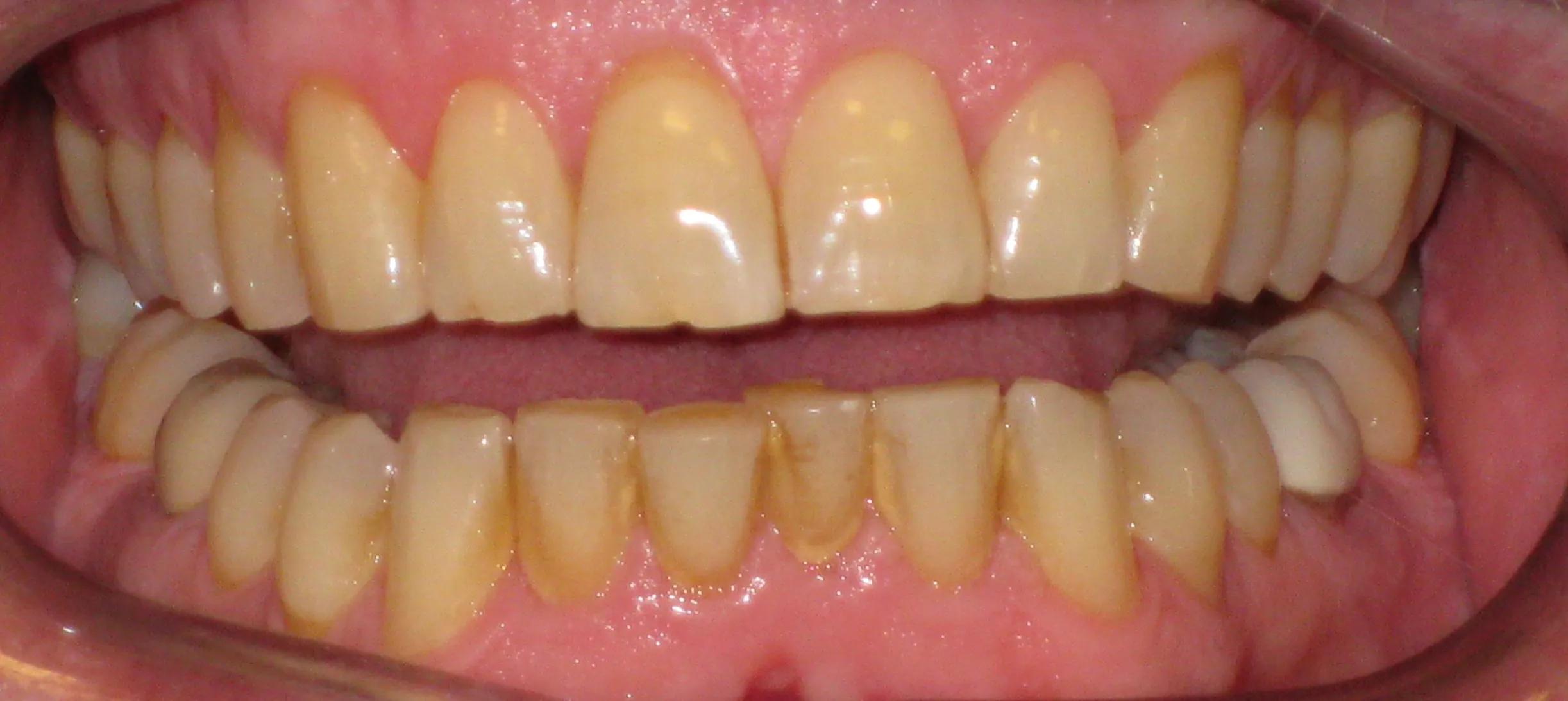 /img/32375-teeth-whitening-process.webp