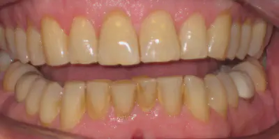 /img/32375-teeth-whitening-process.webp